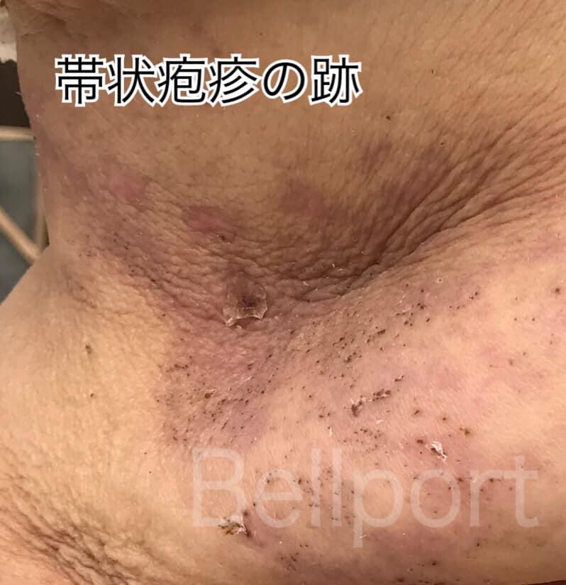 帯状疱疹 帯状疱疹の跡 痛い 痒い 跡が残る
