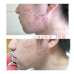 にきび 治したい メディティア エイジェレブ スキンケア