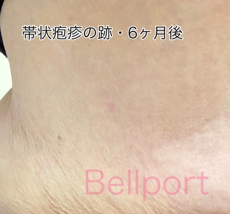 帯状疱疹 帯状疱疹の跡 メディティア使用